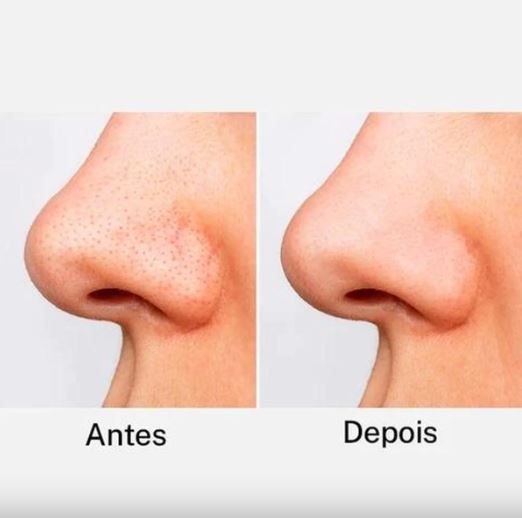 Removedor de Cravos Lanbena® Limpeza de pele Profunda